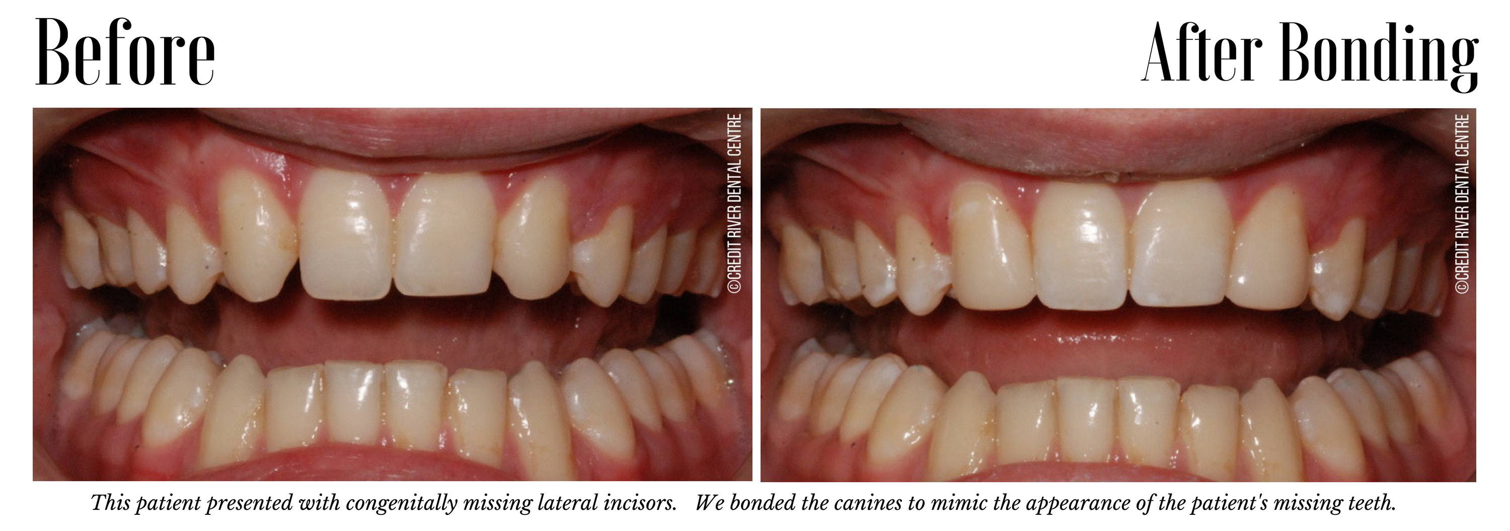 Before and after dental bonding on front teeth
