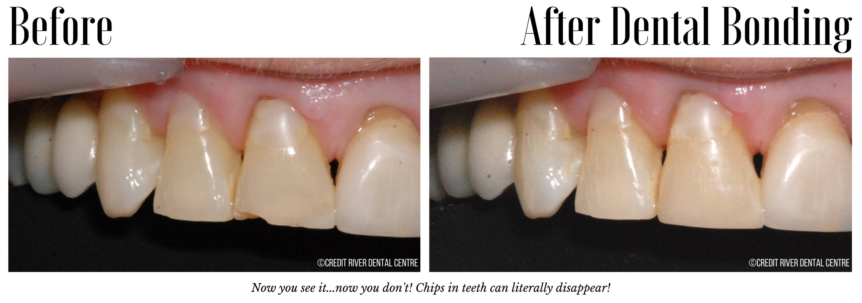 Before and after dental bonding for chipped tooth
