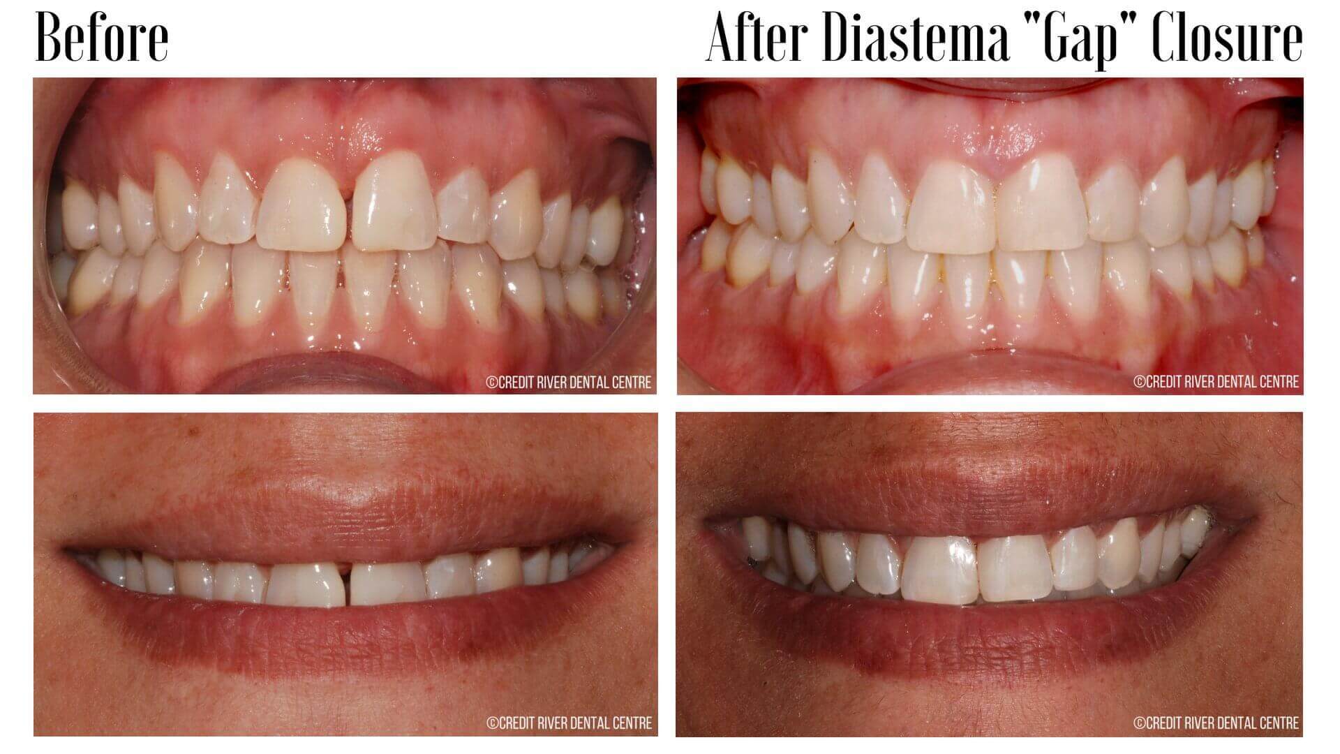 Before and after diastema (gap) closure treatment
