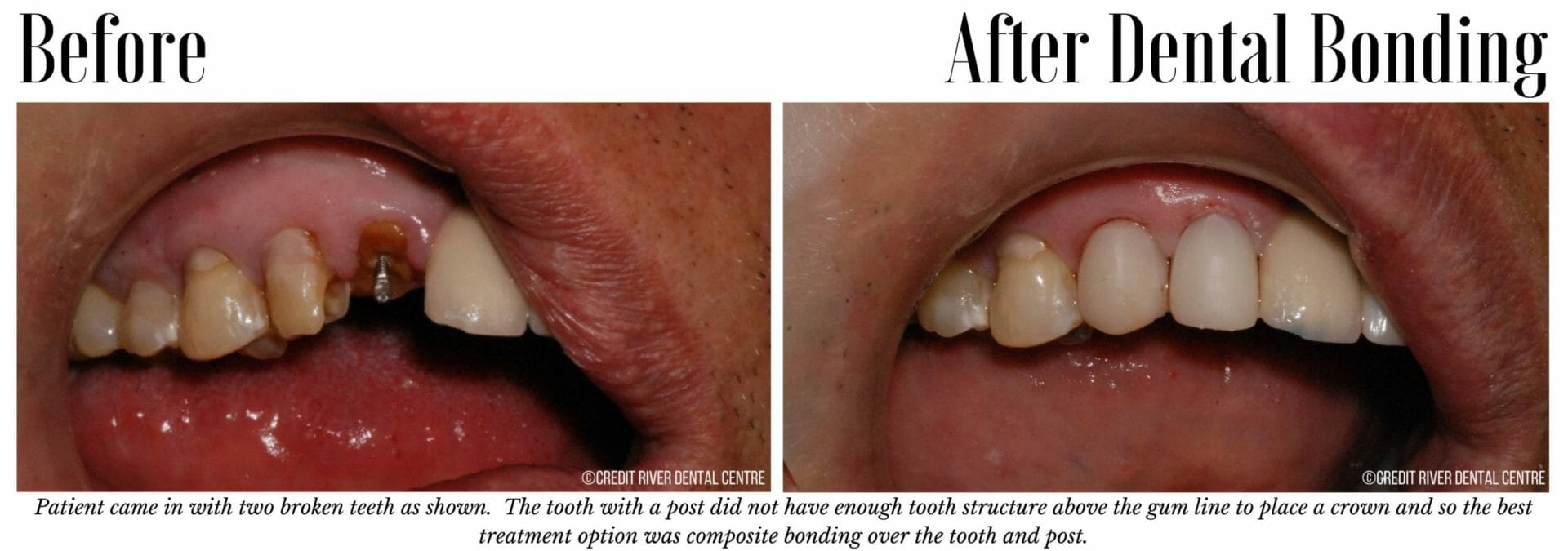 Before and after bonding for broken front teeth
