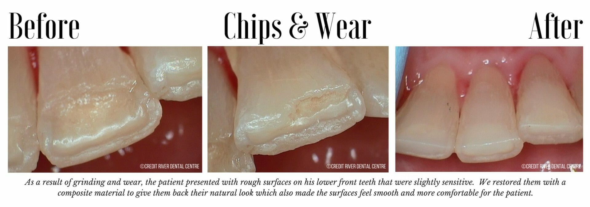 Teeth restoration after chips and wear
