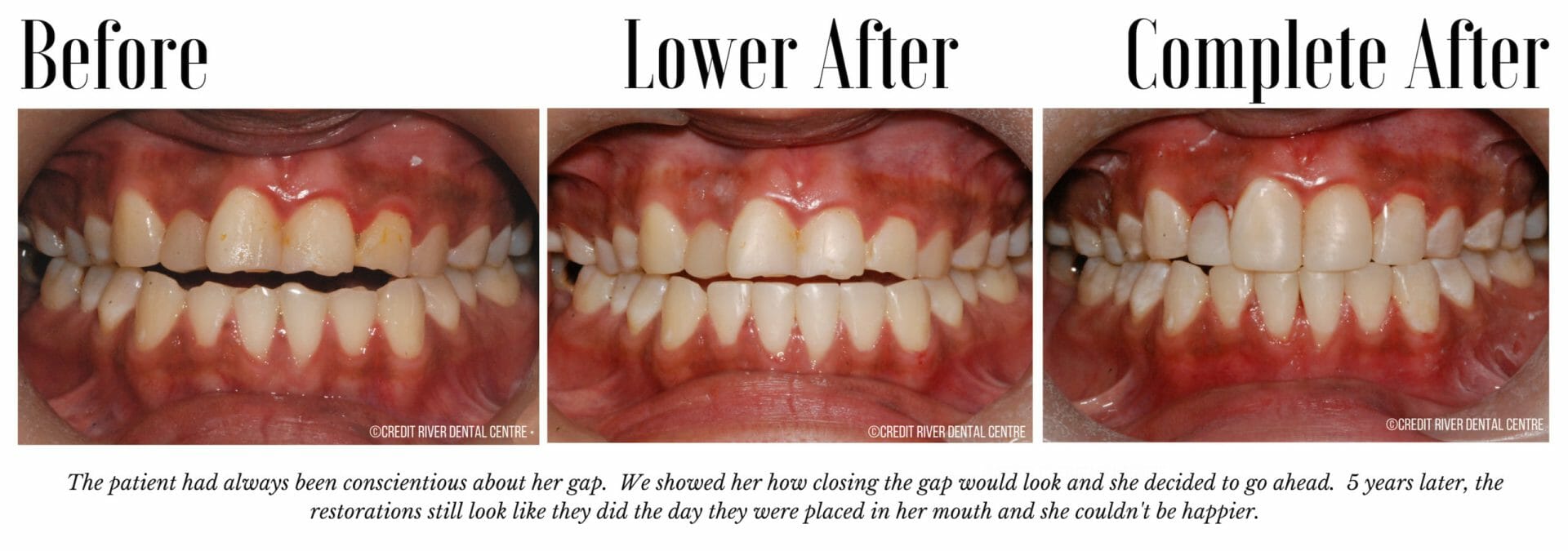Before and after closing front teeth gap
