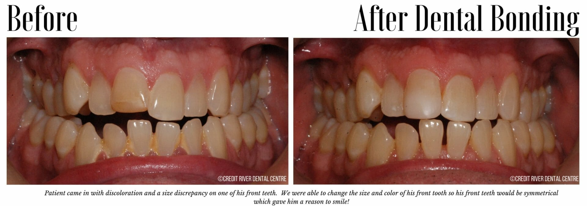 Before and after bonding for front tooth fix

