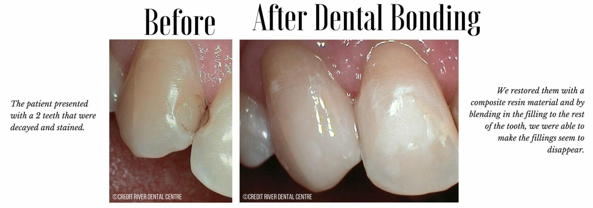 Before and after bonding of decayed teeth
