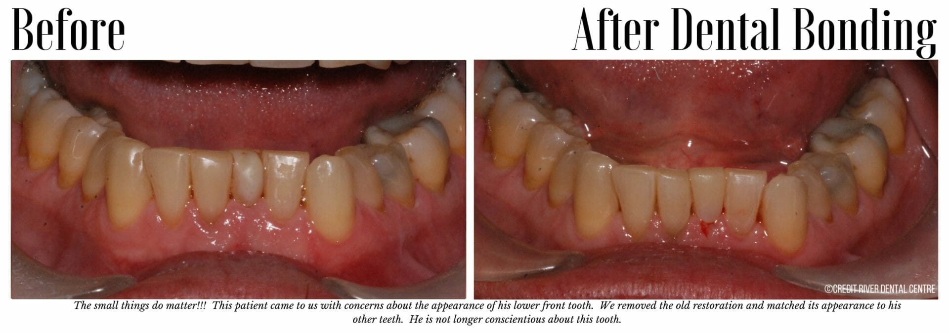Before and after lower front tooth bonding
