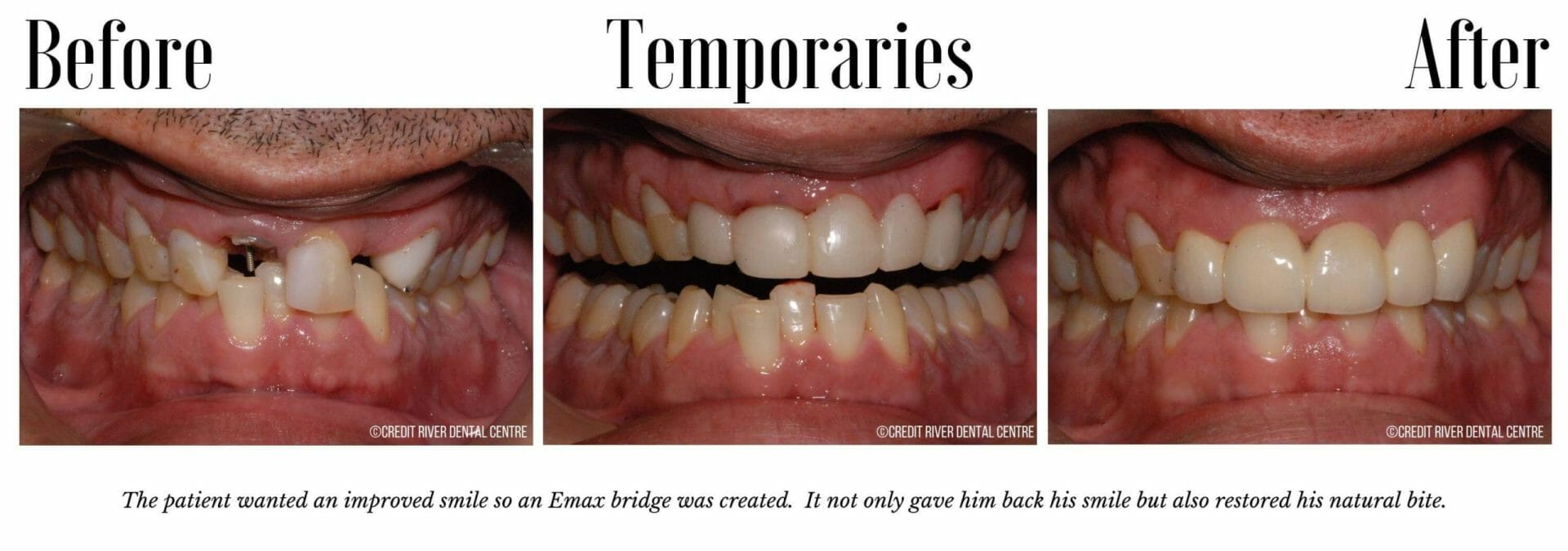 Before and after dental bridge restoration photos