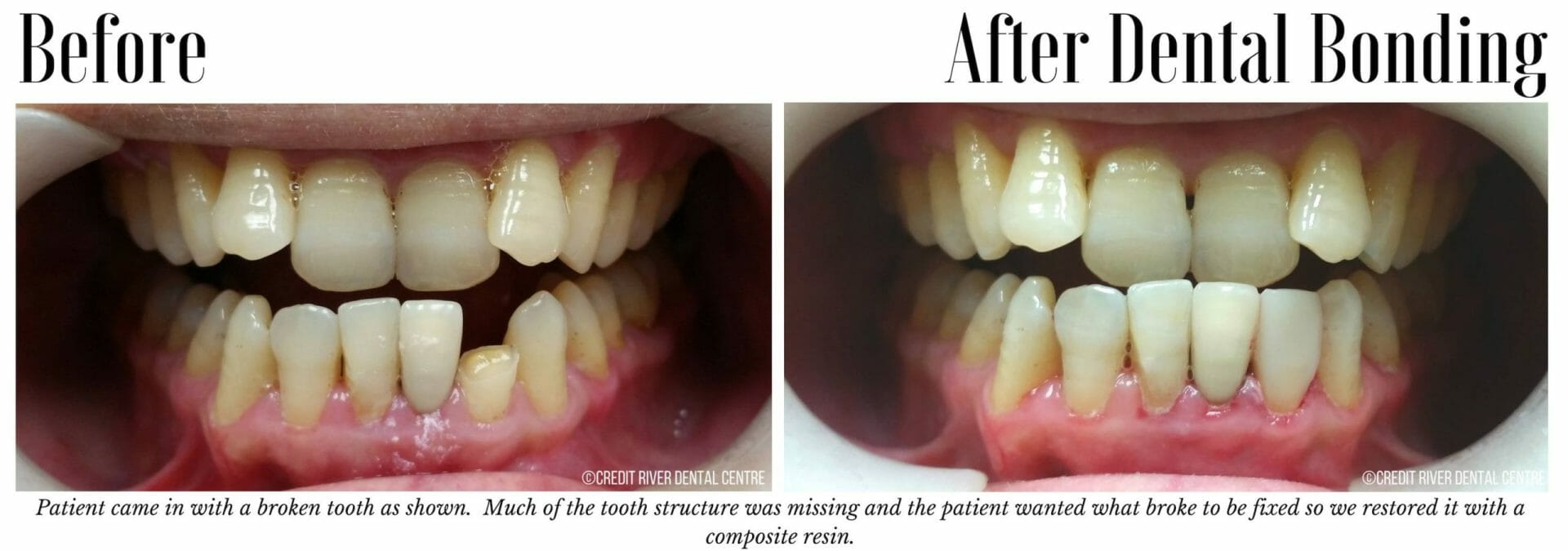 Before and after bonding of broken tooth
