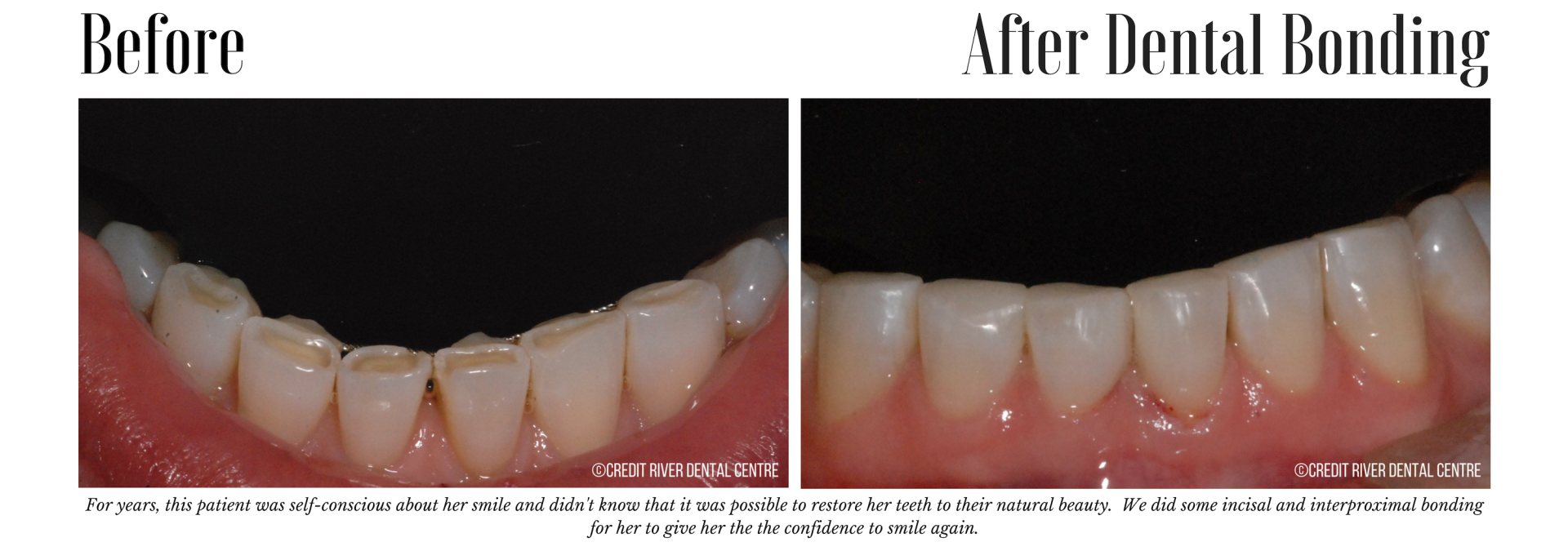 Teeth restoration with dental bonding results
